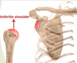 Arthritis shoulder